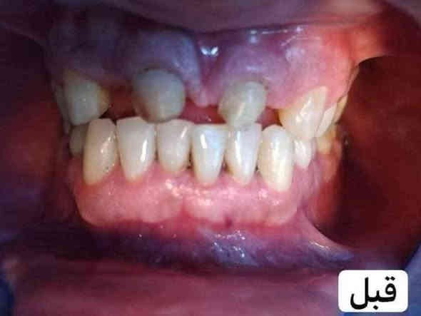 اللي يريد يحجز يتصل او يدز عالخاص 

عيادة طب الاسنان 
تقويم الاسنان ،، زراعة الاسنان ،، حشوات تجميلية
تركيب الاسنان (سيراميك و زارگون)،، حشوات جذور ،، قلع،، حشوات مؤقتة ودائمية ،، تنظيف وتلميع الاسنان ،، تبييض الاسنان بالليزر 
متواجدين طيلة أيام الاسبوع 
للحجز والاستفسار ع الخاص او ع الرقم 
*********** واتساب 
العنوان .. الامين الثانية شارع البنازيخانة يم السوگ 
قریب ع افران السلام واسواق الشارقة مقابل محلات الصبيحاوي
مجمع دكتورة رجاء محمد نصيري
