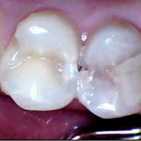 علاج تسوس مجاني • جامعة العميد السعدية • خلف مول الحارث