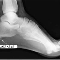 شوكة القدم • حجامة • طويريج