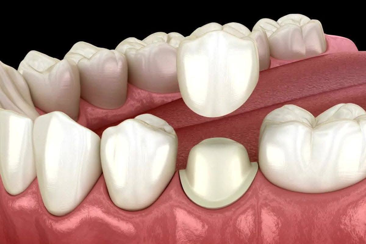 علاج مجاني 
السلام عليكم
اي احد عندة سن مفقود بالأسنان الخلفية نكدر نعوضها  بجسر ثابت يعني نغلف السن  العلاج مجاني بالكامل 
الي محتاج تعويض وتغليف انان يتواصل ويانا 
***********
