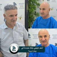 زرع شعر • مركز لەنیا • كلار