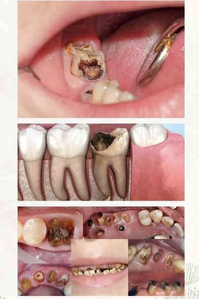 🔴علاج اسنان مجاني وباشراف اطباء اختصاص 
_قلع
_تنظيف اسنان 
_حشوات  ضوئية
_تقويم متحرك
_طقم كامل متحرك
_حشوات اطفال وفلورايد ( ماده تمنع تسوس اسنان الاطفال)
_علاج مشاكل اللثة والتقرحات 
_علاج الام المفصل الصدغي
_اشعة وفحص للاسنان  
📍عيادات جامعة الكوفه خلف كليه الفقه
للحجز والاستفسار: 
@manar_w44 
***********
