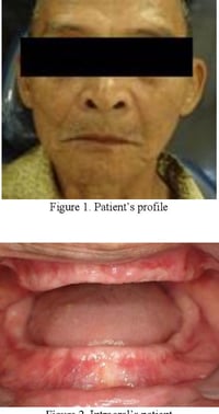 فقدان الأسنان كاملة • طقم كامل متحرك • بدون قلع