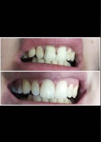 النجف الأشرف • علاج تسوس أمامي • مجانا