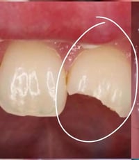 الي عنده كسر ب اسنانه مثل الصوره ويحتاج حشوه ضوئية  خ يتواصل وياي العم...