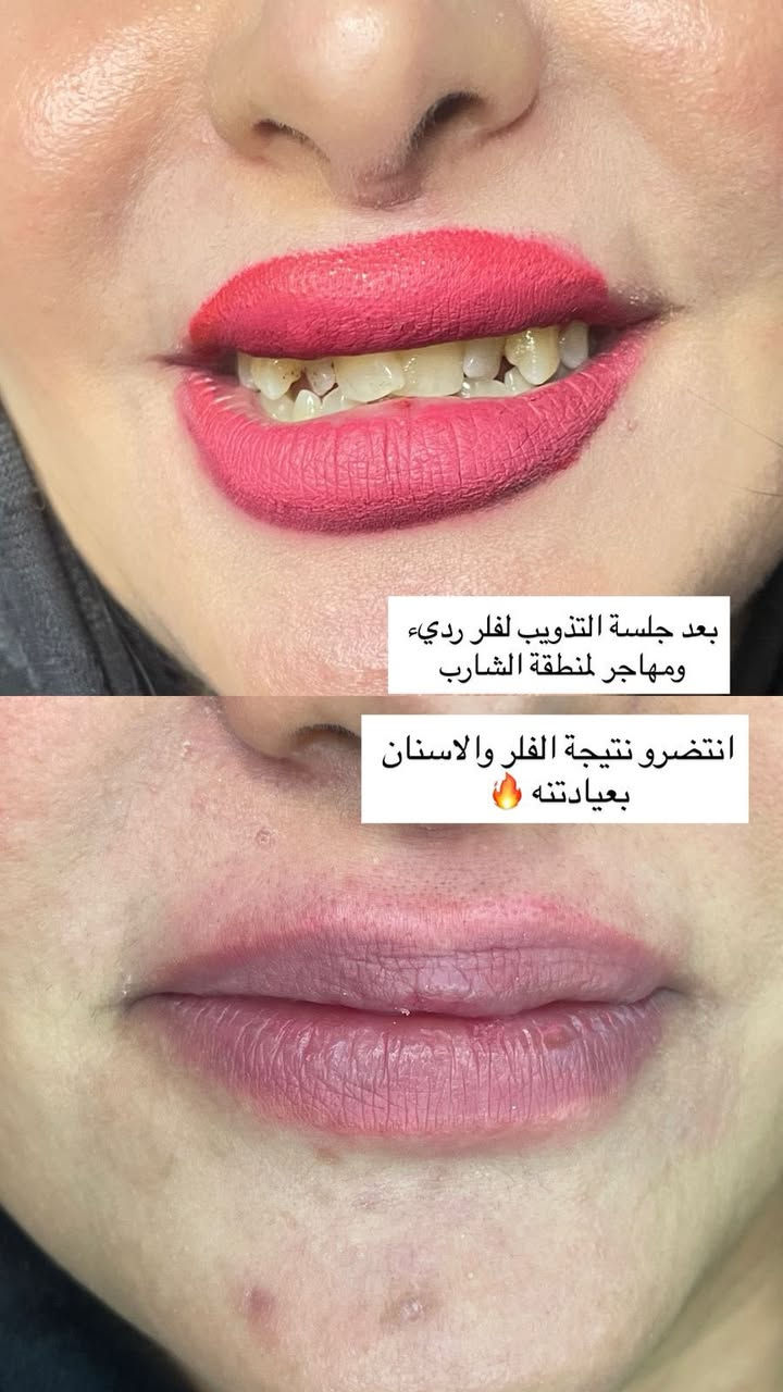 زيركون بسماية لطب الاسنان والتجميل
كلشي متوفر بالنقد وبالتقسيط بدون مقدمة للموظفين والمتقاعدين 

عرض العيد الكل ينتظرة سارعو الحجز
- فلر كوري+بلازمة مفعلة  100 
- فلر بلجيكي+بلازمة مفعلة 125
ومتوفر فلر سويسري و ايطالي براند
- تذويب فلر فوري — ٣٥ ألف
- ⁠بوتوكس باودر لكل الوجه 125
- ⁠ميزو هالات وتصبغات ومكس تفتيح 75
- ⁠بلازمة مفعلة+بي ار بي للتساقط 50
- ⁠ابر نظارة براند بجميع انواعها 

الحقن يتم بيد طبيبات الاختصاص الدكتورة زهراء نجاح وباستخدام مواد أصلية مفحوصة من وزارة الصحة لضمان نتيجة آمنة وجميلة 💎
———————————————————
—العنوان بغداد-مقابل مجمع بسماية السكني-السايد الراجع من بغداد-على الخدمي .
  للحجز+اسفسار ***********زيركون بسماية
