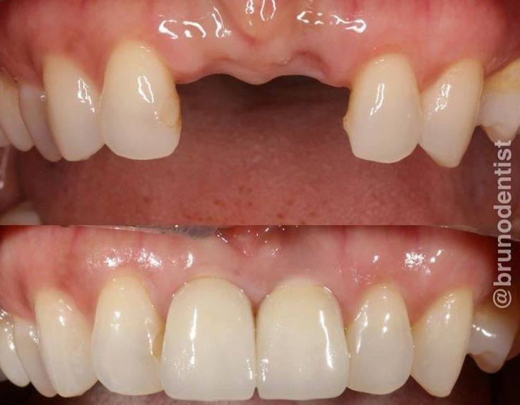 السلام عليكم
أني طالبة جامعية بجامعة دجلة  الدورة ،
 اللي يحتاج قلع مثل ماموضح بالصورة 
أو عندة السن الامامي مكسور ويحتاج حشوة
 او شخص فاقد جزء من الاسنان 
حتى انعوضها 

علماً ان العمل تحت إشراف اطباء مختصين
📍 العلاج داخل العيادات الجامعية واني اتكفل بكل مصاريف العلاج
ف اللي مهتم أو يعرف شخص محتاج، يتواصل ويايه عالخاص 
او واتساب ***********
