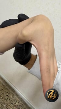 طگ طگ بالمفاصل عند الأطفال بدون ألم ( حالة من العيادة )   🔹 طفلة عمرها...