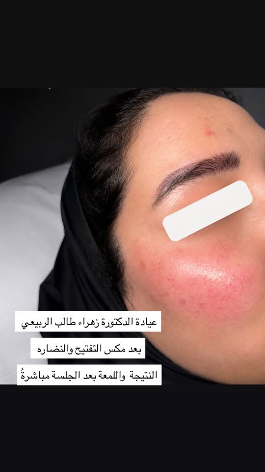 عيادة الدكتورة زهراء طالب الربيعي 

شكراً لثقتكم وتجربتكم عيادتنا خلال وقت قصير من الافتتاح 💐💐💐💐💞💐💐

بسبب اقبالكم المستمر ولكثرة الرسائل والمطالبة بالعروض 💉💉💉👄

🛑🛑عروض شهر السابع بلشت من هسه 

لمعرفة العروض والاسعار مراسلتنا واتساب ***********  💉💉💉💗
