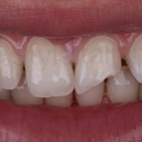 علاج أسنان • مجاناً • موصل شلالات