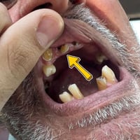 ،،،منو محتاج قلع جذور الأسنان التالفه # مجاني ،،،، يتواصل وياي على الو...