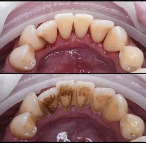 🔴علاج اسنان مجاني وباشراف اطباء اختصاص 
_قلع
_تنظيف اسنان 
_حشوات  ضوئية
_تقويم متحرك
_طقم كامل متحرك
_حشوات اطفال وفلورايد ( ماده تمنع تسوس اسنان الاطفال)
_علاج مشاكل اللثة والتقرحات 
_علاج الام المفصل الصدغي
_اشعة وفحص للاسنان  
📍عيادات جامعة الكوفه خلف كليه الفقه
للحجز والاستفسار: 
@manar_w44 
***********
