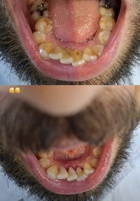 طالب طب اسنان رابعة • تنظيف تكلسات مجاني • شارع فلسطين