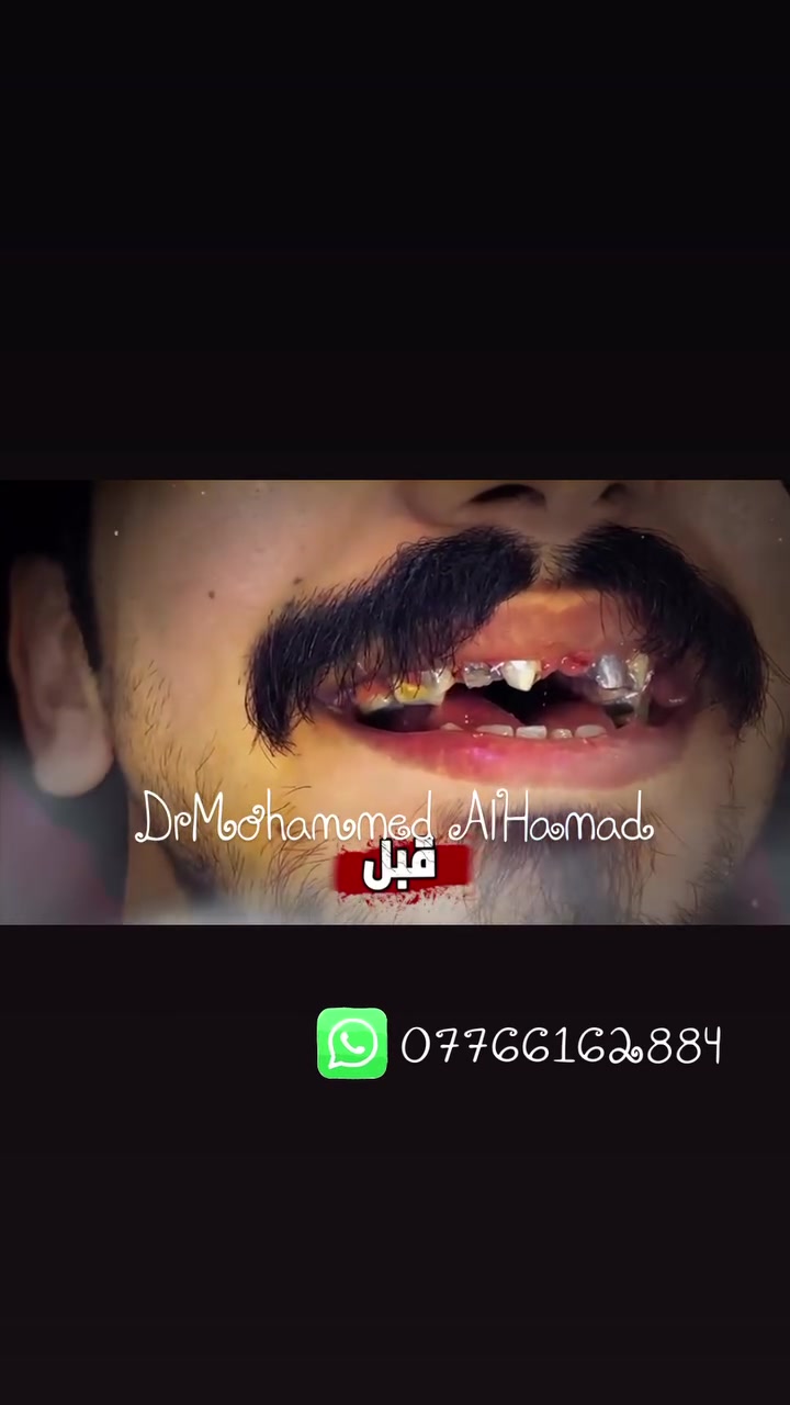 عروض خاصة على ابتسامات الاسنان نتعامل مع افضل المختبرات لانتعامل بالابتسامات التجارية ‼️⚠️  لابتسامة اكثر ثقة وجمال للحجز والاستفسار التواصل على واتساب ***********   عروض على الزيركون السن الواحد 75

