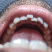 تنظيف اسنان • زراعة وتغليف بالتقسيط • بابل/جبله