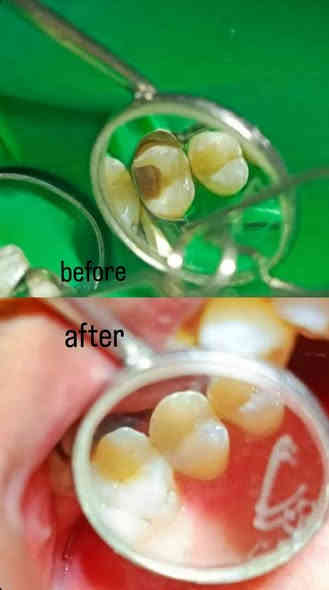 ⚡️ 30% خصم الآن!  عرض لا يُفوَّت! ⚡️

الدكتور وليد الفهداوي (بكالوريوس طب وجراحة الفم والأسنان
، سيرتفكت حشوات جذور ) يقدم :

​💰 العرض الأقوى (لفترة محدودة)!

​مجاناً: تنظيف وإزالة التكلسات والتصبغات عند حجز جلسة التبييض بالليزر!

​خصومات تصل إلى 30% على حشوات الضوئية و حشوات الجذور والقلع.

​فحص واستشارة مجانية لجميع الحجوزات.

​📞 احجز الآن!

للحجز ​اتصل على: ***********
العنوان: الرمادي _ الصوفية _ البومحل _ مجاور ملعب شهداء البومحل
