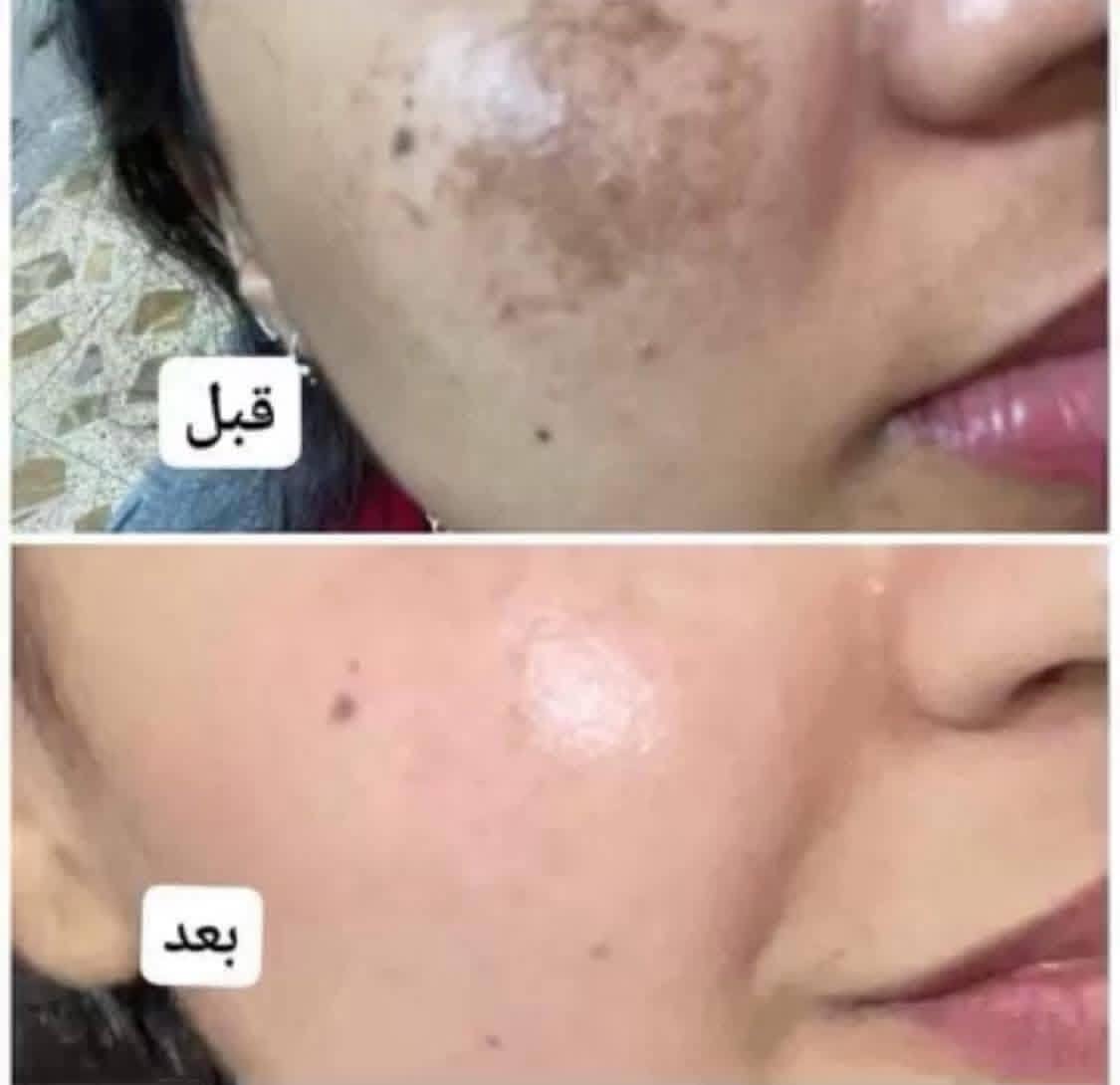 السلام عليكم تتوفر خلطة تبيض وتصفية الوجه مع صابونه الفرق يبين من ثالث استعمال تجارب الزبائن بالتعليقات وعندي خدمة توصيل داخل الدبس فقط الخلطة لكلا الجنسين ذكر او انثى السعر 7000.د التوصيل 1000.د 
للحجز مراسلتي


**إذا كنت صاحب هذا الإعلان وتريد حذفه لأي سبب، رجاءا أرسل رسالة إلى الدعم الفني**