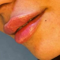 فيلر شفة • ازالة تاتو • مجمع علم الكندي