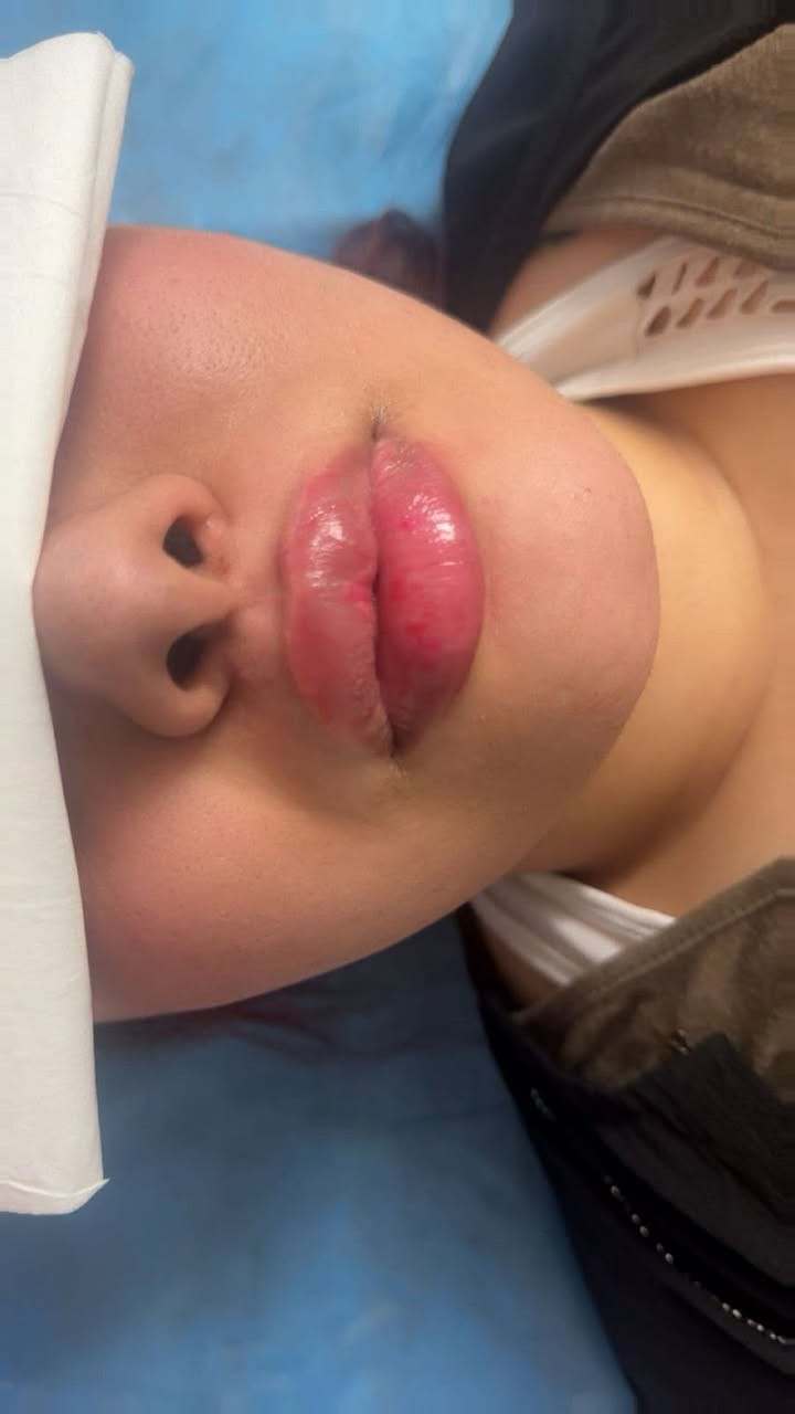 حقن فلر الشفاه👄 بطريقة ناعمة لمراجعتي الجميلة 
 
الهدف من الحقن💉إبراز الجمال الطبيعي وليس تغييره ❤️‍🔥

ميرو للَتجْميل واللَيزَرْ
للحجز والاستفسار :***********
ميرو للَتجْميل واللَيزَرْ
بنات تعير يجنن
@إشارة
