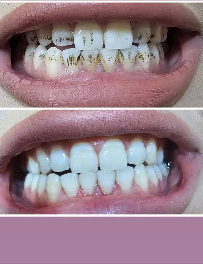 السلام عليكم 
 متواجدين بعيادة اصلان 
لقسمين الاسنان والتجميل 
يوميا من الساعه 4 ولليل حسب الحجوزات 
للحجز ***********
نستقبلكم بكل حب 💙
