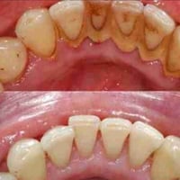 عيادات جامعة الهادي • علاج مجاني • طقم اسنان متحرك