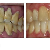 متوفر لمن لديه حالات مشابه لهذه الحالة تنظيف اسنان مجاني للحجز 0775205...