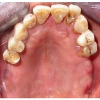 تعويض الاسنان مجانا الي عنده فقد باسنانه مثل هاي الحالات يكتبلي أو يتو...