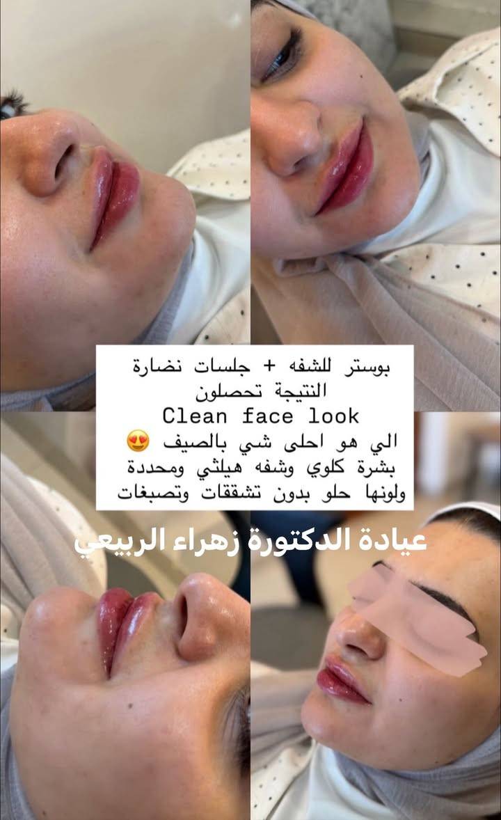 عروض شهر السابع بلشت من هسه حتى تحصلون على افضل نتيجة بموسم المناسبات💓💓💓⭐️‼️

العروض كلش تفيد العرايس ونصيحة اي عروسة تحب بشرتهه تلمع وبيها امتلاء وحيوية تشوف اخر ابرة نزلتهه الدكتورة على صفحتهه وياهه تنظيف بشرة مجاناً

لمعرفة اسعار العروض والحجز مراسلتنا واتساب ***********💓

المسيب / شارع البلدية
عيادة الدكتورة زهراء طالب الربيعي
قسم التجميل اللاجراحي💓
