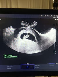 حامل ٧ أسابيع • تكيس مبايض • كركوك حي الحجاج