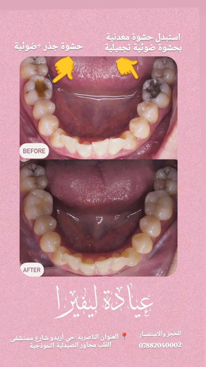 عيادة ليڤيرا لطب وتجميل الاسنان 
 حشوات ضوئية تجميلية.حشوات جذور
        من أعمالنا داخل العيادة 

نستقبل يومياً قبل وبعد الافطار
    للحجز والاستفسار.***********

📍 العنوان الناصرية-حي أريدو شارع مستشفى القلب مجاور الصيدلية النموذجية 
#متابعين #حشوةجذر #عيادةاسنان #تنظيف_اسنان #أبتسامة_هوليوود
