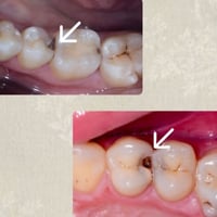 الي عندة مثل هذا التسوس ويحتاج حشوة يراسلني  او يتصل 07749947644