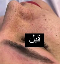 تنظيف بشره • تنظيف بشره عميق • هايدروفيشل • عروض تنظيف بشره • صالون تج...