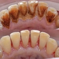 حشوات تجميلية • قلع الأسنان • عيادات جامعة بلاد الرافدين