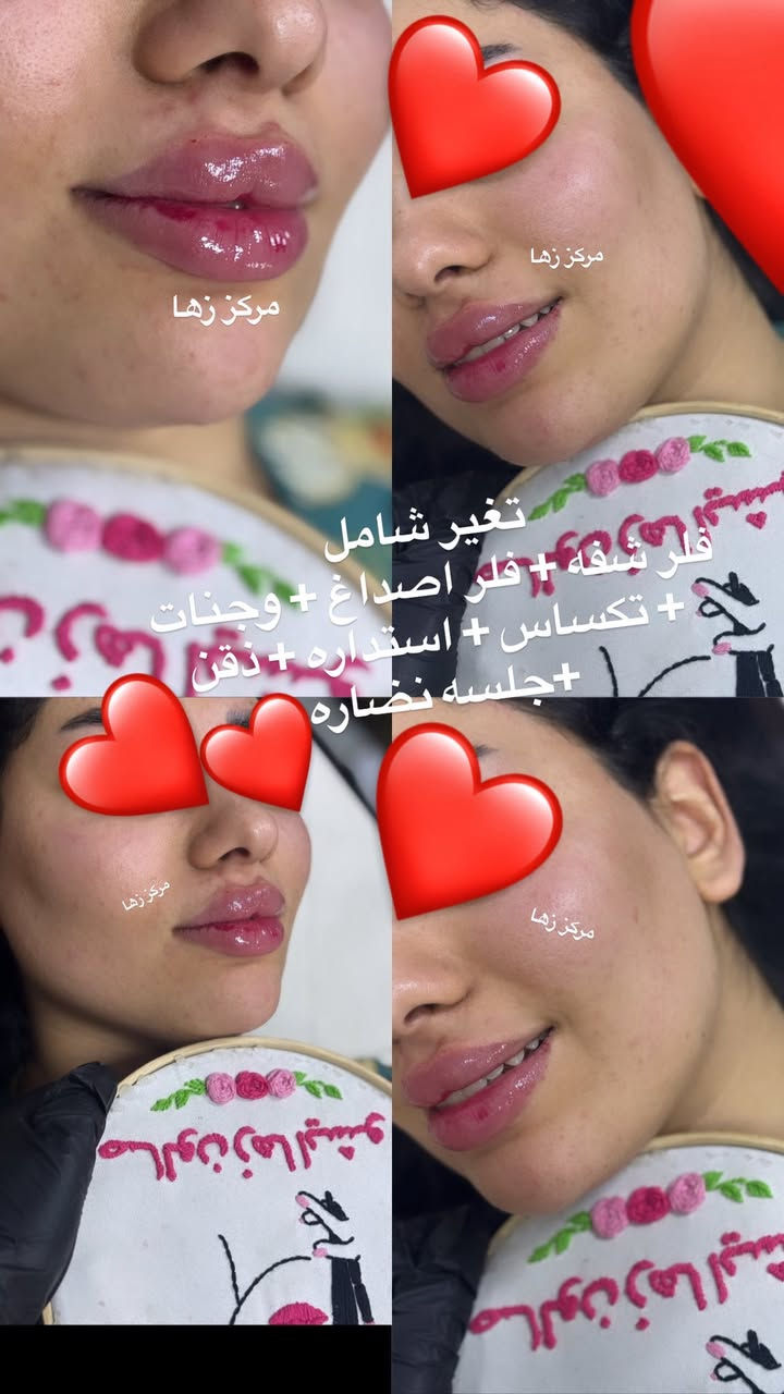 عروض قنبله  الموسم عروض لمده محدوده فقط 
على جميع الأقسام لمده محدوده فقط 

نبدي بأكثر قسم احبه تجميل 

فلر اودري تغير شامل 12 سيسي ب 200 فقط 
فلر اودري تغير شامل 6 سيسي ب 100 فقط 

فلر ابتك تغير شامل  12 سيسي ب 450 فقط 
فلر ابتك تغير شامل 6 سيسي ب 225 فقط 

فلر سويسري تغير شامل 12 سيسي ب 950 فقط 
فلر سويسري تغير شامل 6 سيسي ب 475 فقط 

بكج اميرات زها 
فلر وجنات مع فلر شفه مع جلسه نضاره ب 100 فقط 

بكج اميرات زمرده فلر وجنات مع فلر اصداغ مع فلر شفه مع فلر ذقن مع جلسه نضاره ب 150 

درمابن ب 15 فقط مع تنظيف البشره العادي هديه 
درمابن مع ميزوا ب 20 مع تنظيف البشره العادي هديه 
درمابن مع ميزوا مع تنظيف البشره العميق ب 25

جلسه نضاره ب 35 
جلسه نضاره مكس ب 50 
جلسه نضاره مكس زها ب 75 
جلسه نضاره مكس زمرده ب 100 فقط 

تنظيف البشره العميق فقط ب 10 
تنظيف البشره ملكي ب 15 
تنظيف البشره العادي ب 5 

بكج أميرات زمرده حف وجه مع تنظيف البشره 
مع تنظيف القدم ومع جلسه معالج البارد للشعر كل هذا ب 20 الف فقط 

قسم عرايسنه الحلوات 
حنه مع عرس ب 150 

ميك اب مع تسريحه بسيطه 25 
ميك اب بناتي ب 10 
ميك اب بسيط ب 15 
ميك أب Vip ب 35 مع رموش دائميه او أسبوعيه حسب اختيارج 
كوي شعر ب 10 
سشوار ب 15 
ويفي ب 10 
تسريحه Vip ب 25

قسم الشعر 
صبغ الشعر القصير ب 15 الف فقط 
الوسط ب 20 
الطويل ب 25 
الطويل جدا ب 35 

تخصيل الشعر  القصير ب 25 
الوسط ب 35 
الطويل ب 40 
الطويل جدا ب 50 

قسم التاتو والوشم والرموش 
تاتو بلوك ب 30
تاتو فيبروز ب 50 
تاتو نانو بروز ب 65 
وشم حرف ب 5 فقط 
وشم صغير جدا ب 15 
وشم صغير ب 20 
وشم وسط ب 30 
الكبير من 40 وفوك حسب حجم الوشم 

رموش أسبوعيه ب 5 فقط 
رموش دائميه ب 15 فقط
رموش دائميه ب 25 فقط 3D
رموش دائميه ب 40 فقط 6D

تسريح ومعالج الشعر 

القصير 35 
الوسط ب 45 
الطويل ب 75 
الطويل جدا ب 100 

للاستفسار واتساب *********** ادمونه زهراء 
عنوان سبع البور شارع 60 مقابل مركز الصحي مقابل حسينية اهل البيت ع
