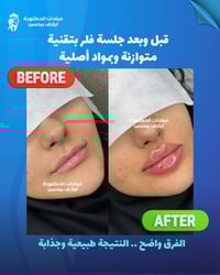 فلر • تجميل غير جراحي • عيادة إيلاف محسن