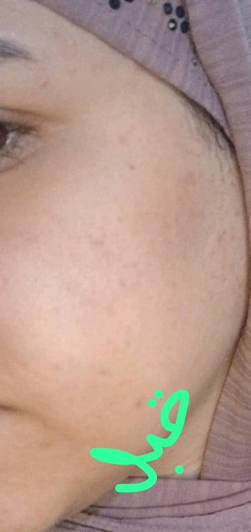  شنو هيه الخلطه الملكيه؟؟

 هيه مجموعه من منتجات فوريفر جمعناهه الكم بعلبه وحده 

راح تشتغل على علاج التصبغات والكلف البسيط والحبوب 
موبس هيج 
راح تنطي للبشره صفاء ونظاره وامتلاء طبيعي 
لانو تحتوي على فيتامينات مغذيه للبشره مثل AE
وايضا راح ترمم وتحمي حاجز البشره 

يعني راح تاخذين منتج واحد ينطينه نتائج عده