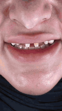 🔥 عرض ابتسامة زاركون لهذا الاسبوع
برد بسيط + شغل مختبر احترافي
لون وشكل حسب اختيارك
نتيجة طبيعية وثابتة

عيادة الدكتورة هند الحسيني 
***********
الامين الثانيه/شارع المهداوي /فوق صيدلية غزوان باسم
