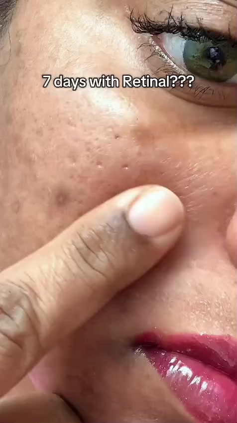 سيروم ذا فيتا ريتنال شوت لشد البشرة من سيليماكس - 15مل

خطوة صغيرة بسيروم، فرق كبير في بشرتك

فعالية المنتج:

يمنح بشرتك شدًّا واضحًا ويعيد لها مظهرها المشدود والشاب.
يعزز مرونة الجلد بفضل قوة الريتنال والمغذيات النشطة.
يساهم في تقليل التجاعيد العميقة والخطوط الدقيقة تدريجيًا.
يقدم عناية مركزة لتفتيح بشرتك الباهتة ومنحها توهج طبيعي.
يجدد خلايا البشرة ويحفّز دورتها الحيوية لتصبح أكثر امتلاءً ونضارة.
يقلل من علامات الشيخوخة المبكرة الناتجة عن العوامل البيئية.
يمنح بشرتك ملمسًا ناعمًا وحريريًا مع ترطيب متوازن.
يساعد على استعادة حيوية بشرتك المرهقة والمتعبة.
يقدم عناية مركزة لشد المسام وتحسين مظهرها.

مميزات المنتج :

يحتوي على الريتنال النقي المعروف بفعاليته العالية في شد البشرة ومحاربة التجاعيد.
غني بالفيتامينات والعناصر المغذية لاستعادة إشراقة البشرة.
قوام خفيف سريع الامتصاص لا يترك أي أثر دهني.
تركيبة لطيفة تناسب معظم أنواع البشرة، بما فيها البشرة الحساسة (مع الاستخدام التدريجي).
مركّز بجرعة فعالة تمنح نتائج واضحة بمرور الوقت.
عبوة عملية صغيرة (15مل) مثالية للسفر والاستخدام اليومي.
مدعوم بتقنية سيليماكس للعناية المكثفة بالبشرة لمظهر صحي ومشدود.
يمنح نتائج مزدوجة: شد + ترطيب + تفتيح في منتج واحد.

طريقة الاستخدام:

نظفي بشرتك جيدًا وجففيها بلطف.
ضعي 2–3 قطرات من السيروم على الوجه والرقبة.
دلّكي بلطف بأطراف الأصابع حتى يمتصه الجلد بالكامل.
استخدميه في المساء فقط (لأن الريتنال يتأثر بالشمس).
ابدأي باستخدامه مرتين إلى ثلاث مرات في الأسبوع، ثم زيدي تدريجيًا حسب تحمل بشرتك.
لا تنسي تطبيق كريم مرطب بعده للحفاظ على ترطيب البشرة.
في النهار، احرصي دائمًا على استخدام واقي شمس لحماية البشرة.


**إذا كنت صاحب هذا الإعلان وتريد حذفه لأي سبب، رجاءا أرسل رسالة إلى الدعم الفني**