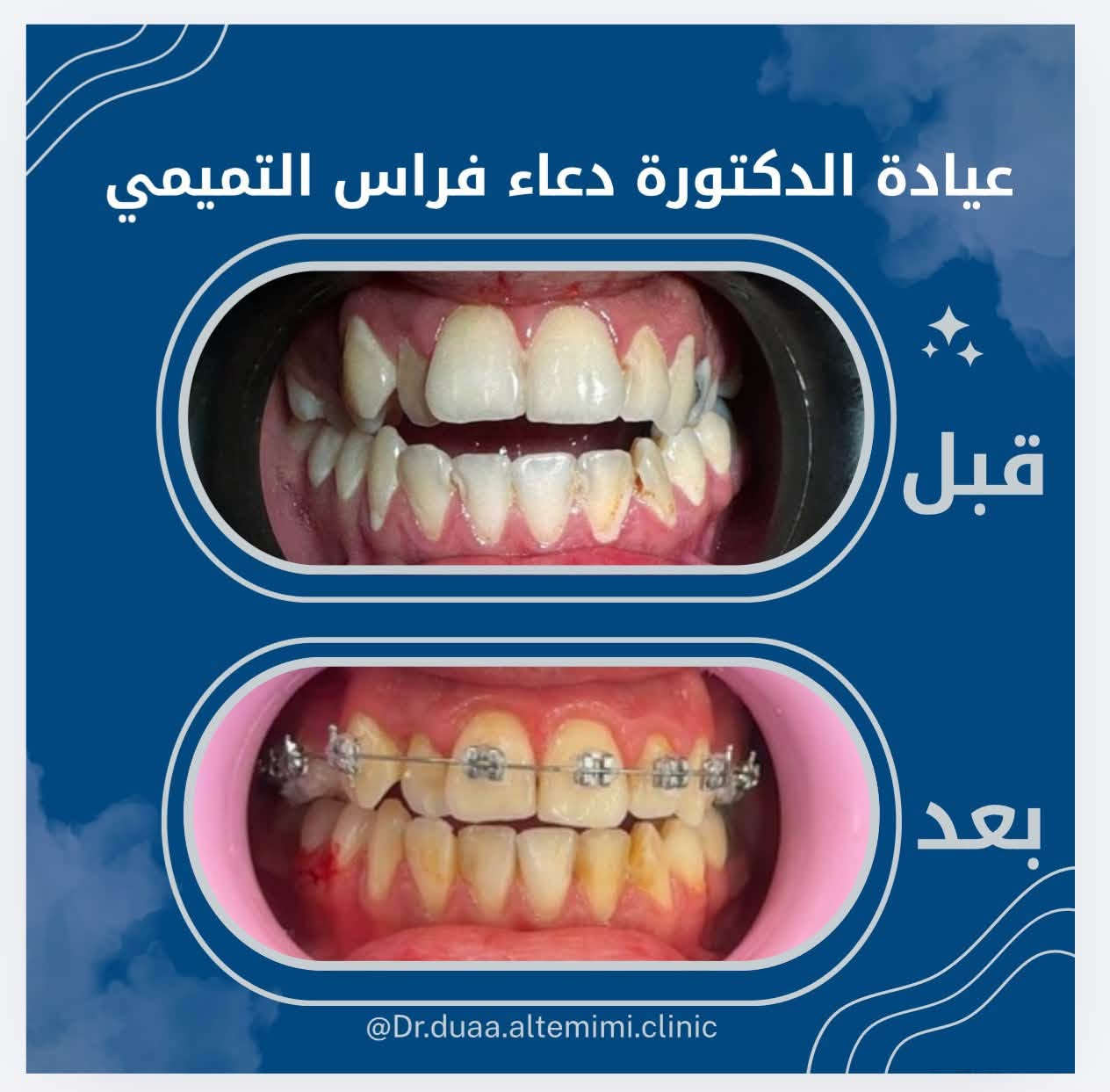 🦷عيادة الدكتورة دعاء فراس التميمي 🦷
-لعلاج الاسنان بالتقويم الشفاف والمعدني 
-زراعة الاسنان وعمل التراكيب السنية بالزاركون والسيراميك 
-عمل الحشوات التجميلية وحشوات الجذور 
-تنظيف وتبيض الاسنان بالليزر 

📍الكمالية - شارع الجامع  - مقابيل مثلجات الفريداوي 

🕠اوقات الدوام من الساعة 4 الى 2بعد منتصف الليل  جميع ايام الاسبوع 

📞للحجز والاستفسار :

***********
