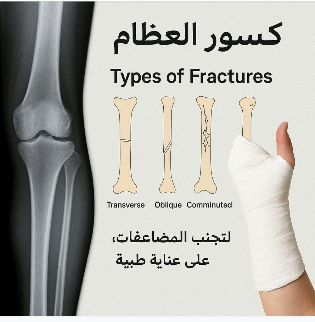 كسور العظام: ليس مجرد آلم عابر

إذا تعرضت لسقوط أو ضربة قوية وشعرت بألم شديد أو تورم أو حتى صعوبة بالحركة، لا تستهين بالأمر!
قد يكون لديك كسر يحتاج لتدخل طبي عاجل.

📍 ما هو كسر العظم؟

كسر العظم هو انقطاع أو شرخ في استمرارية العظم نتيجة قوة خارجية، مثل السقوط أو الحوادث، أو بسبب ضعف العظام كما في هشاشة العظام.

⸻

⚠️ أسباب كسور العظام
 • السقوط من ارتفاع أو التعثر.
 • حوادث السير أو الإصابات المباشرة.
 • الإصابات الرياضية.
 • هشاشة العظام أو أمراض تقلل من قوة العظم.
 • الإجهاد المتكرر (كسور الإجهاد لدى الرياضيين).

⸻

📝 أنواع كسور العظام
 1. الكسر المغلق: العظم مكسور لكن الجلد سليم.
 2. الكسر المفتوح: العظم يخترق الجلد (خطير ويتطلب تدخل فوري).
 3. الكسر المشروخ (شعري): شرخ صغير بالعظم، غالبًا بسبب إجهاد متكرر.
 4. الكسر المتعدد الأجزاء: العظم مكسور لعدة قطع.
 5. كسور الإزاحة: نهايات العظم تتحرك عن مكانها الطبيعي.

⸻

🩺 أعراض كسور العظام
 • ألم شديد يزداد مع الحركة أو الضغط.
 • تورم أو كدمات.
 • فقدان القدرة على تحريك الطرف المصاب.
 • تشوه واضح أو بروز العظم في الكسور المفتوحة.

⸻

💉 العلاج
 • التثبيت بالجبيرة أو الجبس: للكسور البسيطة.
 • التثبيت الداخلي (صفائح ومسامير): للكسور المعقدة أو التي تحركت.
 • التثبيت الخارجي: في الحالات التي يوجد فيها ضرر شديد بالأنسجة.
 • العلاج الطبيعي: بعد إزالة التثبيت لاستعادة الحركة والقوة.

⸻

💡 نصائح للمريض بعد الكسر
 • الالتزام بمدة التثبيت التي يحددها الطبيب.
 • تناول غذاء غني بالكالسيوم وفيتامين D.
 • تجنب التحميل الزائد على الطرف المصاب.
 • بدء تمارين التأهيل تدريجيًا تحت إشراف مختص

#الدكتور #عزيز #حسين #خليل #الزبيدي 
 اختصاص جراحة العظام والمفاصل والكسور
واسط #الزبيديه..#شارع الأطباء..مجاور #صيدليه #باقر حبيب 

#للحجز #والاستفسار
***********📞🛑
***********📞🛑

#كسور_العظام #جراحة_العظام #المفاصل #علاج_الكسور #هشاشة_العظام #إصابات_الرياضة #صحة_العظام
