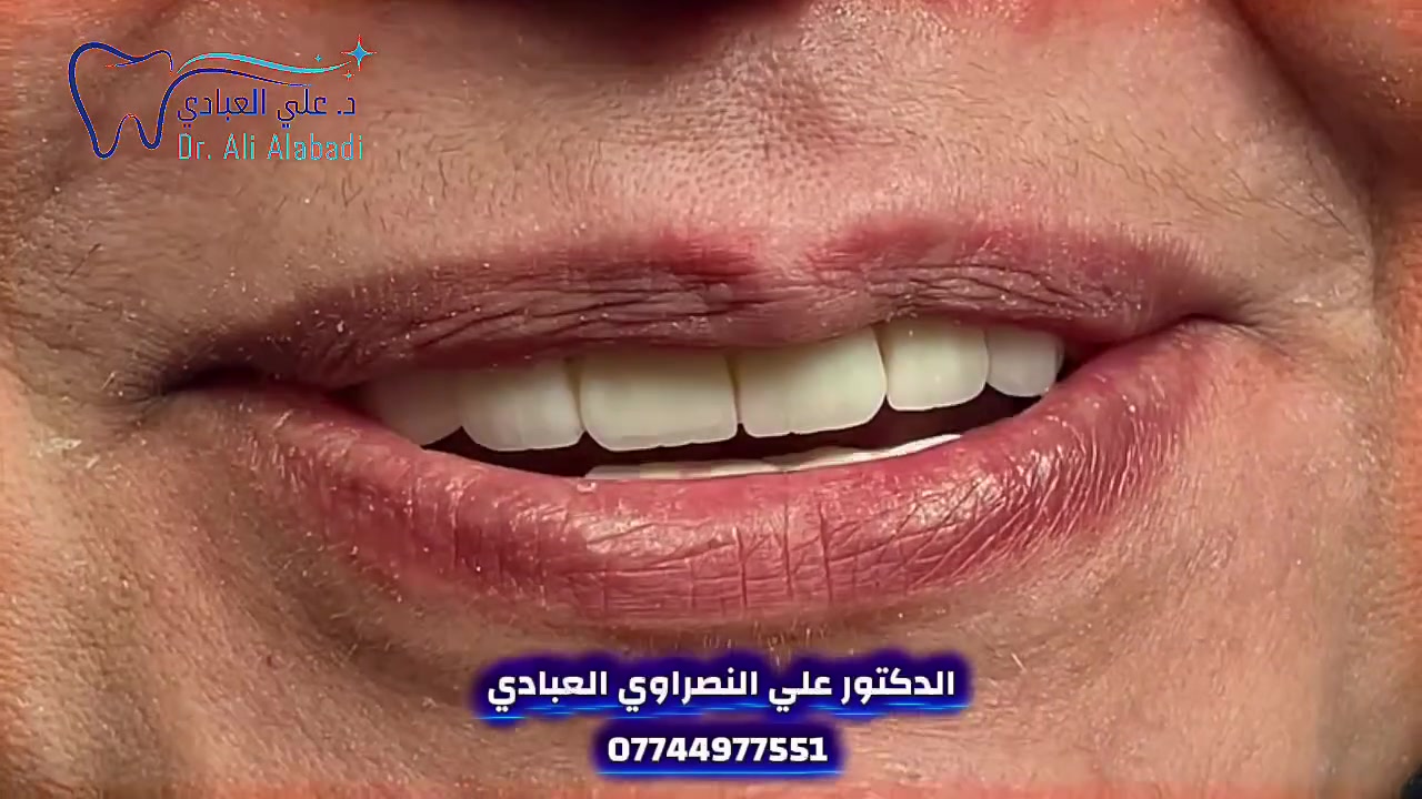 العنوان: ضحكتك.. هي سرّ جاذبيتك! ✨
📌📌📌((يتوفر لدينا نظامين الاقساط))  :
١- نظام الاقساط على ماستر كارد.
٢- نظام الاقساط العيادي .
مع خدمة العلاجية الأسنان مجانا  في ((عيادة الدكتور علي النصراوي العبادي ))
*********** / ***********
العنوان : الحرية ثالثة _ابوجفات مقابل أسواق الشمري / فوق مطعم دجاج الرحمن  
((الدكتور علي العبادي ))
دوام العيادة من الساعه  2 ظهرا إلى ٩ مساءا (اهلا وسهلا)
للحجز والاستفسار ⁉️⁉️⁉️
‏WhatsApp  
*********** / ***********
