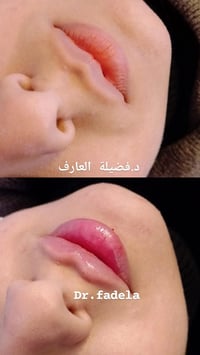 فيلر • مجمع وتد بسماية • د. فضيلة