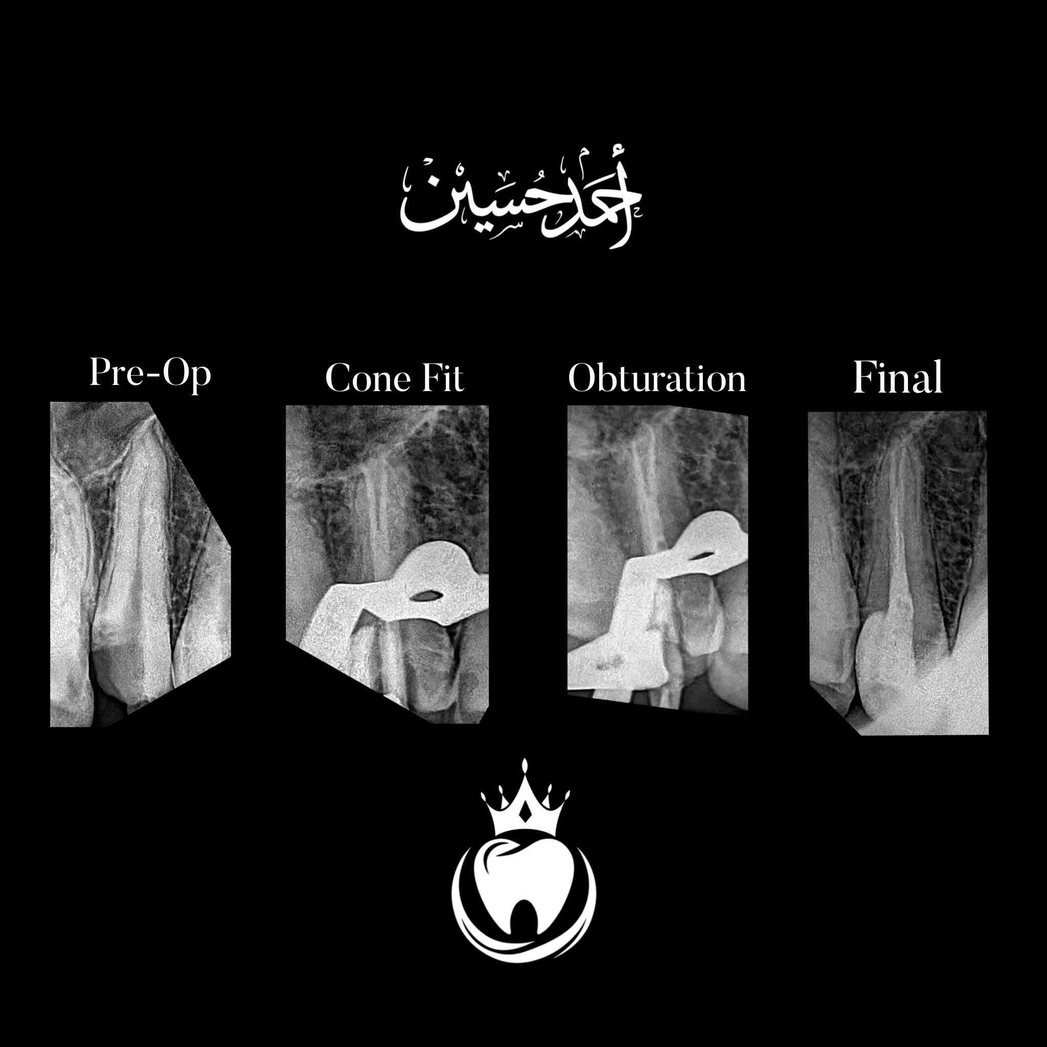و كالعادة مراجعنا يشكو من الم مستمر في السن الضاحك العلوي و العلاج حشوة جذر مع حشوة تجميلية و اختفاء الالم و لله الحمد

الدكتور أحمد حسين الطعماوي 
المجمع الطبي الحديث مجاور مرطبات كرزة
التواجد جميع ايام الاسبوع بعد صلاة العصر الى الساعة ٨:٠٠ مساءََ
للحجز و الاستفسار :***********
