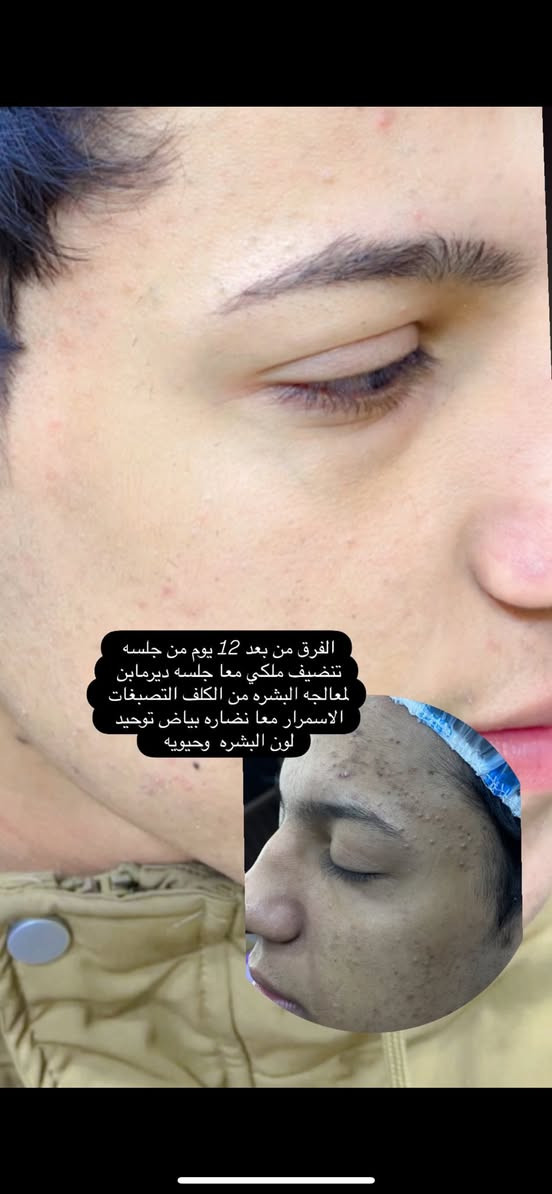 موافقه ادمن جزاك الله خير 🤍
بدت عروض العيـــد 🎉 والخصم لكل مايخص البشره من تنضيف هايدروفشل تنضيف ملــكــ👑ــي معالجه تجميل تغير شامل حقن ابره النضاره جلسات ديرمابن لمعالجه  البشره من العيوب الكلف التصبغات معا نضاره بياض  تصفيه كله متوفر يمي  كل مايخص جلسات وعمل المراكز متوفر بـ اسعار كلش مناسبه 

ام قصر شارع 8 ركن مقابيل موكب ابو هادي 
الماكيـــر حسيـــن. للتواصل. ***********
