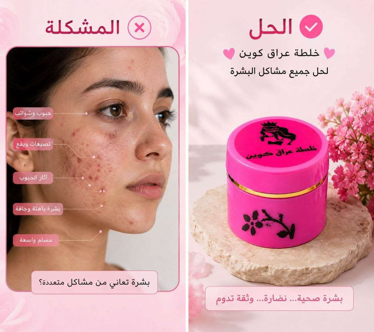 🌸 خلطة عراق 

إذا بشرتج تعبت من الحبوب، الكلف، والتصبغات.. فهذا هو الحل اللي تستحقينه ✨

✔️ تركيبة عشبية طبيعية وآمنة على البشرة.
✔️ ما بيها كرتزون، ديرمودين، ولا أي مواد تضر البشرة.
✔️ تناسب كل أنواع البشرة حتى الحساسة.
✔️ قوامها خفيف وسهل الامتصاص.
✔️ نتائجها تبدي تبين من أول أسبوع مع الاستخدام المنتظم.

شنو تفيد؟
• تخفف حب الشباب.
• تقلل آثار الحبوب.
• توحد لون البشرة وتخفف التصبغات والكلف.
• تنعم البشرة وتعطيها ترطيب ولمعة طبيعية Colombo, Sri Lanka


**إذا كنت صاحب هذا الإعلان وتريد حذفه لأي سبب، رجاءا أرسل رسالة إلى الدعم الفني**