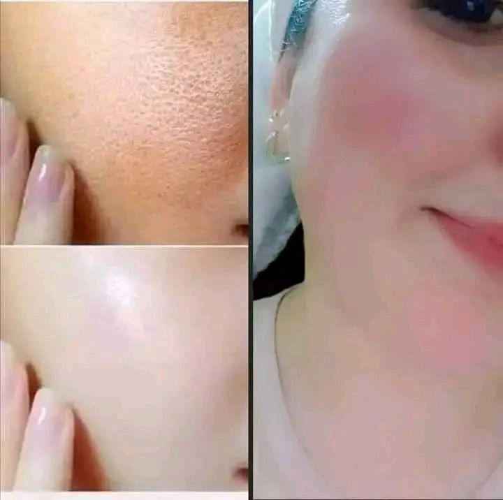 بنات جاجن عيد ما عندي فلوس تسوين ابر نضاره فلر حل يمي
شسويتي لصارت بشرتج هيج
انا رح كلجن الحل يلي تريد بشرة صافيه  وخالية من التجاعيد والبقع والحب كتبي تم لأعطيا العلاج النتيجة اسبوع تلاكي فرق يخبل
#benfica#livestory


**إذا كنت صاحب هذا الإعلان وتريد حذفه لأي سبب، رجاءا أرسل رسالة إلى الدعم الفني**