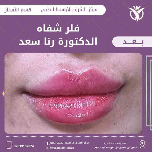 ⁨ حقن فلر 💋ب ايادي الدكتورة رنا سعد🔥

مركز الشرق الأوسط قسم التجميل ✅

📍العنوان ذي قار قضاء الشطرة مدخل حي المعلمين قرب صوره السيد الحكيم

 📲للحجز والاستفسار الاتصال
 على الرقم ***********⁩⁩⁩⁩⁩
