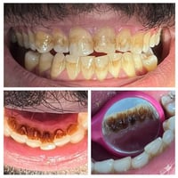 يتوفر علاج اسنان مجاني (حشوات ضوئية، تعويض اسنان مفقودة، قلع بقايا الج...