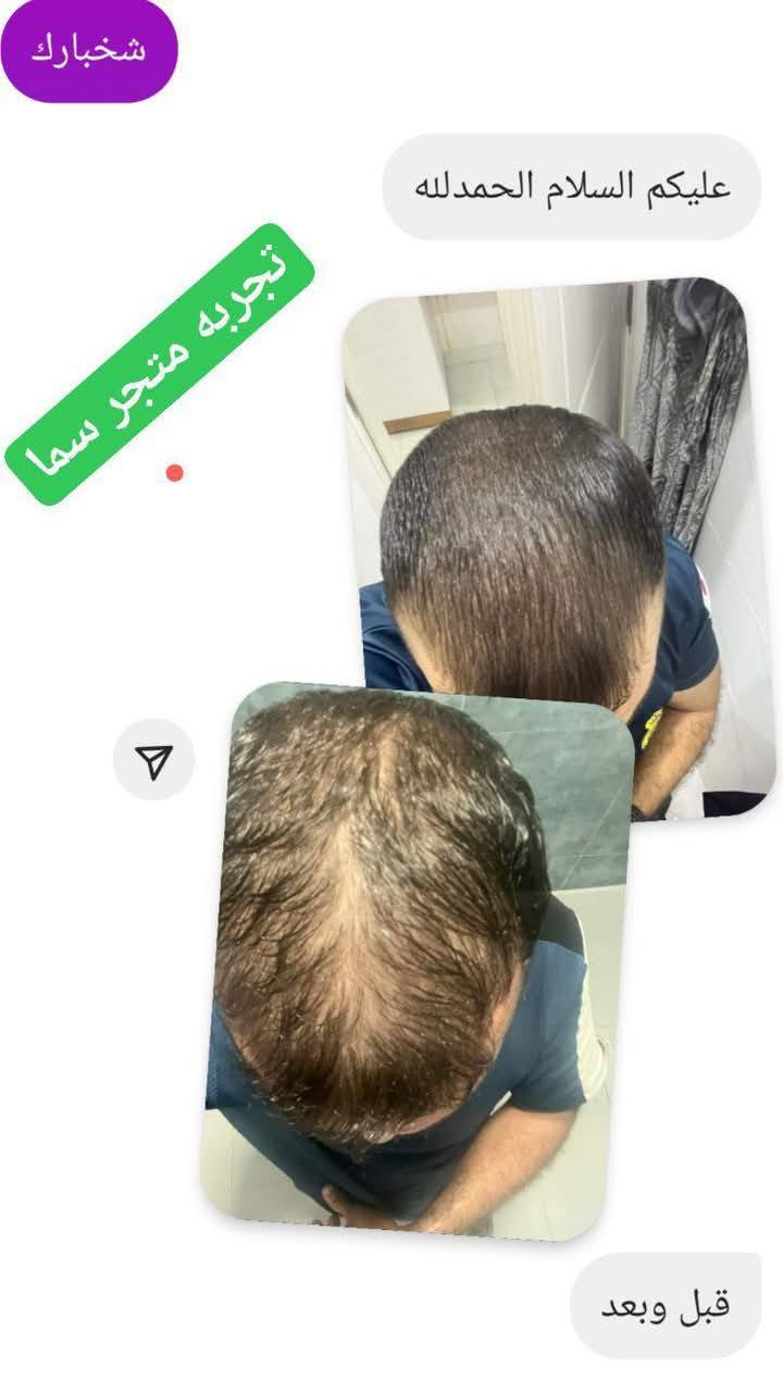 بخاخ الشعر   بديل زراعة الشعر  يعني بعد اليوم متحتاجون زراعة شعر لان البخاخ هاذ يملى الفراغات ويثخن الشعر بمدة اقل من 4 اسابيع تبدي فراغات الشعر نبت بصيلات شعر صغيرة و وبمرور الوقت تكدرون تلاحضون الفراغات بدت تنترس شعيرات صغيرة وهيج يثخن شعر ويطول 
الحل المثالي الجذري للشعر خصلنة من معانات شعري خفيف وشعري قصير وشعري يوكع ماكو بعد والتجارب كدامكم 👇🏻
و الله العظيم الفرق يبين من اول 3 اسابيع


**إذا كنت صاحب هذا الإعلان وتريد حذفه لأي سبب، رجاءا أرسل رسالة إلى الدعم الفني**