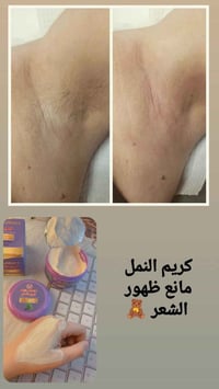 كريم النمل • بديل الليزر • تأخير نمو الشعر